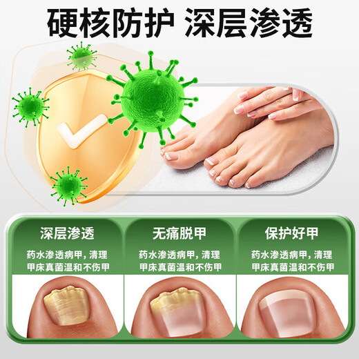 Yunnan Herbal Impatiens for Onychomycosis Antibacterial Onychomycosis Liquid Thickening, Yellowing and Empty Onychomycosis Special Effect Kit
