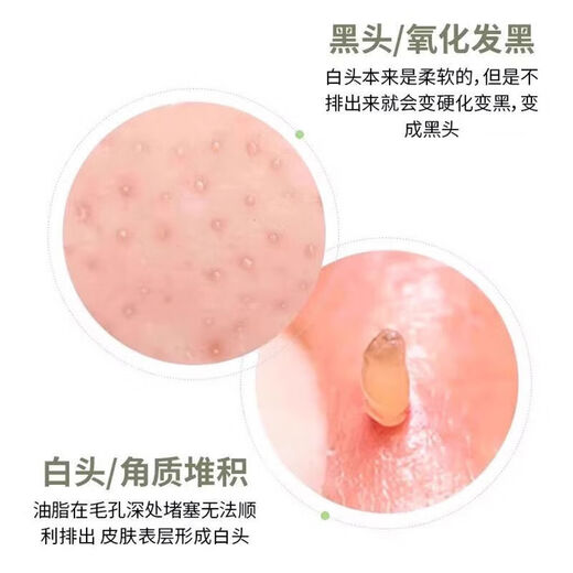 Scrape away blackheads. Portable blackhead scraper. Manual acne facial cleansing hair follicles and pores. Blackhead spatula scraper. Small blackhead spatula for face shaving. Portable 2 pack. Scrape away blackheads + bid farewell to strawberry nose. Mini beauty spatula.