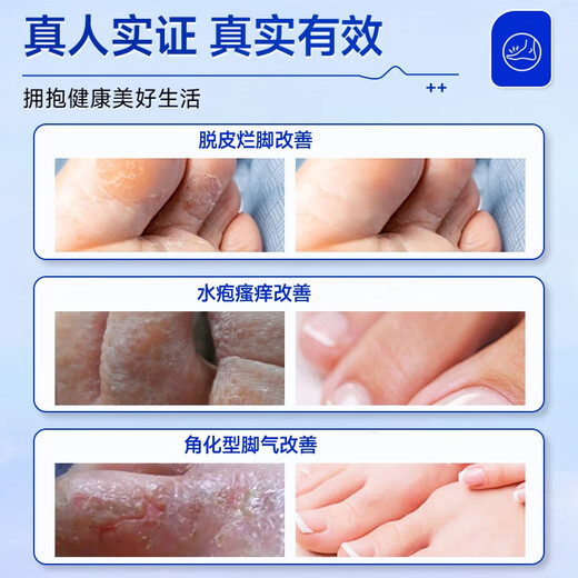 Athlete's foot spray to relieve itching, peeling and rotten feet, fungal infection, deodorizing and root removal, special treatment for smelly and sweaty feet, 3 boxes