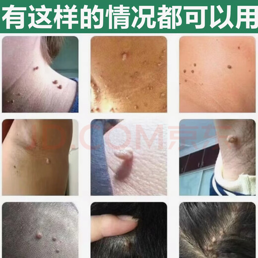 Remove small pimples on the neck, monkey black spots, filamentous thorns, plantar tags, remove flat tags, regular skin tags under the armpits