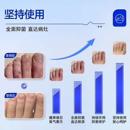 Athlete's foot spray to relieve itching, peeling and rotten feet, fungal infection, deodorizing and root removal, special treatment for smelly and sweaty feet, 3 boxes