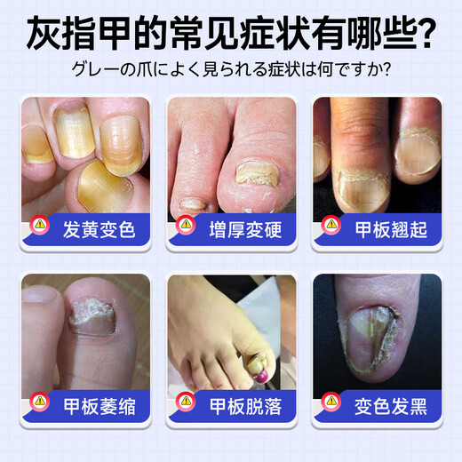 Jianbu Pharmaceutical onychomycosis special for severe nail fungal infection, removal of onychomycosis, thickening and yellowing health care solution 30ml