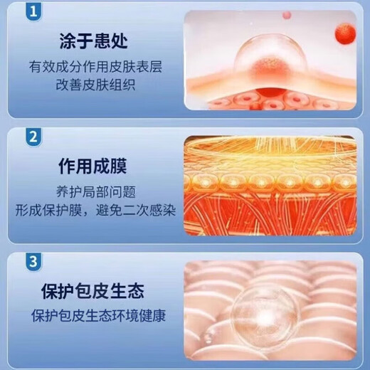 Special medicine for healing foreskin crack inflammation. Special medicine for foreskin crack, redness and swelling. Special medicine for balanitis, fungal infection, foreskin infection, pearl rash. Erythromycin ointment 1 box. Redness and swelling of foreskin crack.