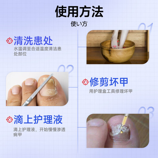 Jianbu Pharmaceutical onychomycosis special for severe nail fungal infection, removal of onychomycosis, thickening and yellowing health care solution 30ml