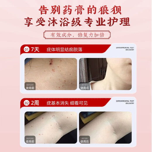 Hong Kong Jing Peitang wart and mole removal soap, small fleshy particles all over the body, flat neck, especially filamentous warts, antibacterial, wart removal, fly feces soap