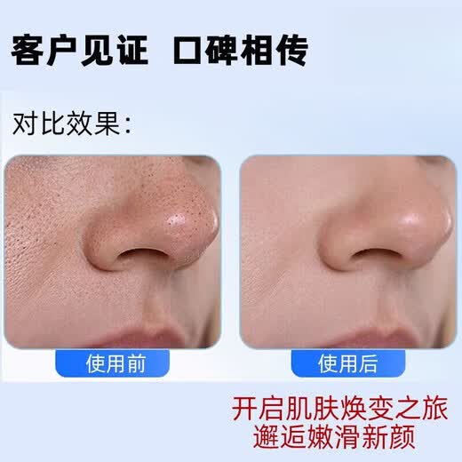 Xiaomi punta artefacto de limpieza de espinillas instrumento para espinillas chupa espinillas y acné limpia los poros instrumento súper succión limpiador de poros limpiador facial limpieza facial doméstica e instrumento de belleza blanco gran poder de succión + movimiento mejorado + algodón, excelente efecto/cinco cabezales de succión