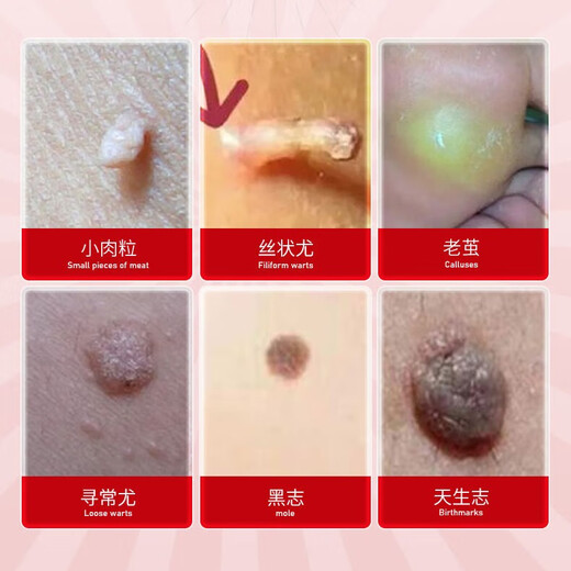 Hong Kong Jing Peitang wart and mole removal soap, small fleshy particles all over the body, flat neck, especially filamentous warts, antibacterial, wart removal, fly feces soap