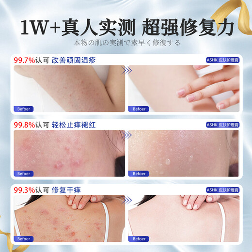 ASHK eczema plaster skin itching erythema antipruritic cream fungal infection sweat herpes anal itching 20g*3 box