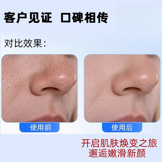 Sawang German Blackhead Cleaning Artifact Beauty Instrument Blackhead Suction Instrument Blackhead Suction Facial Cleanser Suction Blackhead and Acne Oil Instrument Super Suction Pore Cleaner Medical Exclusive Pearl White Super Suction Power + Upgraded Movement 2025 New Upgrade Deep Cleaning Blackhead Buster