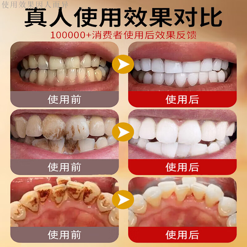 Tooth Champion whitening toothpaste removes plaque, black spots, black lines, pits and fissures, improves tooth yellow and melanin pigmentation artifact