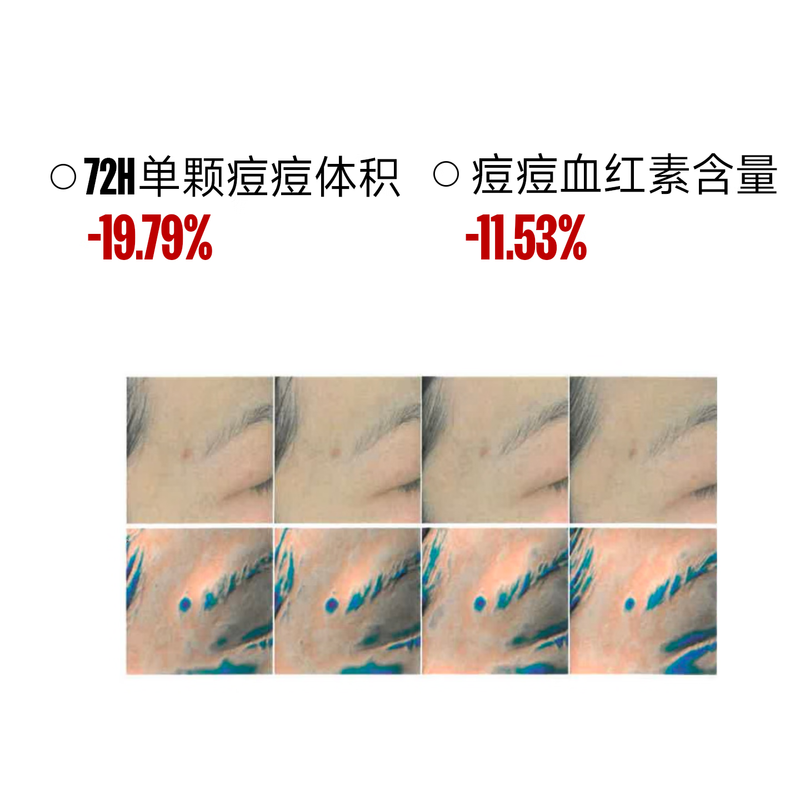 Fufu cleansing and repairing nighttime acne patches, anti-acne, physical suction, pus isolation, pollution, acne removal, acne removal, acne deflation, 36 patches for boys and girls