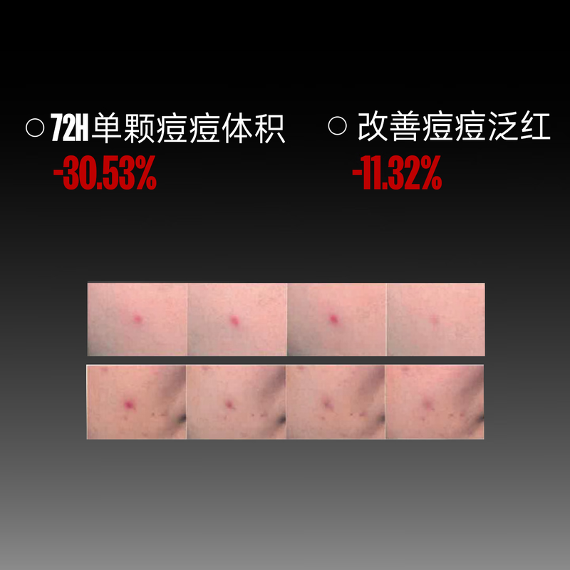 Fufu cleansing and repairing nighttime acne patches, anti-acne, physical suction, pus isolation, pollution, acne removal, acne removal, acne deflation, 36 patches for boys and girls