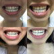 Teeth strips to brighten and whiten teeth, remove yellow and whiten teeth, a tool to dazzle teeth and whiten teeth, 1 box