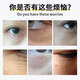 Sweat mandibular tumor removal cream fat particles removal tool oil particles removal white particles for men and women's eyes special eye cream in one box