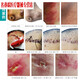 
9930 Medical wound disinfectant burn scald trauma surgery household non-alcoholic disinfection anti-infection spray Old style