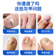 Correct impatiens onychomycosis antibacterial liquid, thick nails, bad nails, empty nails, yellowing, atrophy, discoloration, thickening and turbidity, fungal infection, impatiens onychomycosis antibacterial liquid 1 bottle