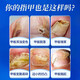 Baiyunshan Huacheng Onychomycosis 100% special effect medicine for nail fungal infection, removal of onychomycosis, thickening of onychomycosis, antibacterial potion, special effect 3 boxes, 90% selection, 2 get 1 free