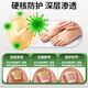 Yunnan Herbal Impatiens for Onychomycosis Antibacterial Onychomycosis Liquid Thickening, Yellowing and Empty Onychomycosis Special Effect Kit