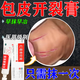 Special medicine for healing foreskin crack inflammation. Special medicine for foreskin crack, redness and swelling. Special medicine for balanitis, fungal infection, foreskin infection, pearl rash. Erythromycin ointment 1 box. Redness and swelling of foreskin crack.