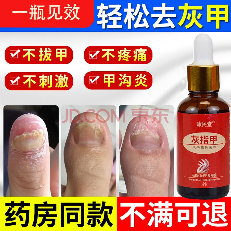 灰指甲药水液去除灰指甲不包扎不修甲灰指甲专用药非灰指甲特效药灰甲