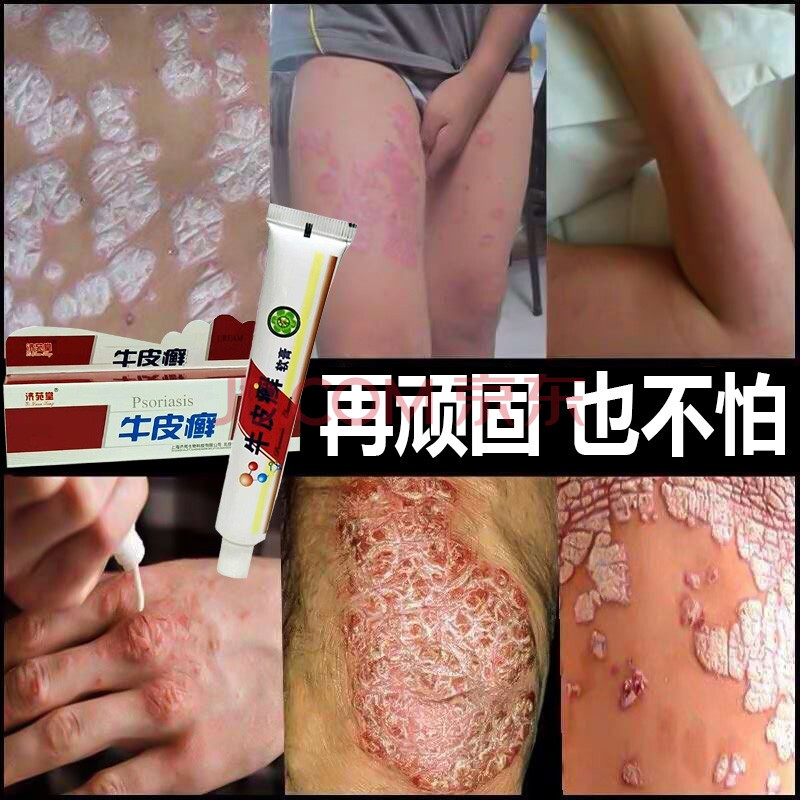 【溫和殺菌不反覆】牛皮膚癬皮膚專用藥外用軟膏軟膏溼疹乳膏皮膚瘙癢