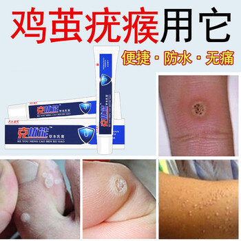 疣克舒软膏去除面部扁疣平脸部手足部一抹灵颈部丝疣状脖子疣瘊净除疣