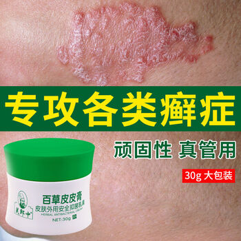 牛皮l癣膏箹特效紫椒癣町手足l癣荨l麻疹皮l炎湿l疹皮肤瘙痒百草止痒