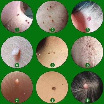 力克宁日本疣瘊灵去除脖子小肉粒祛猴子肉瘤小疙瘩刺猴痦子腋窝脱落膏