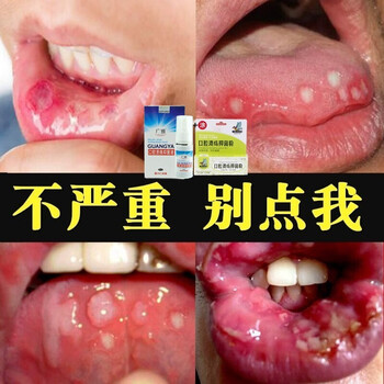 广雅非口腔溃疡喷剂舌头嘴巴起泡口疮上火散贴牙龈肿痛喉咙痛喷雾用药非 喷剂 粉 图片价格品牌报价 京东