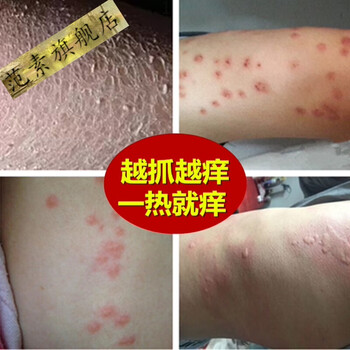 身上有红点皮肤瘙痒全身身上痒冬季皮肤瘙痒干燥起红疙瘩红点外用老年