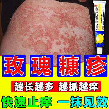 红斑湿疹鳞屑全身痒皮肤瘙痒玫瑰糠疹止痒特效用药膏糠酸莫米松乳膏 2