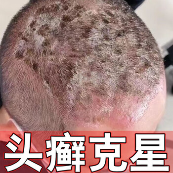癣立净头癣专用i药银屑头皮屑脂溢性皮炎股癣手i足i癣真菌感染药i膏