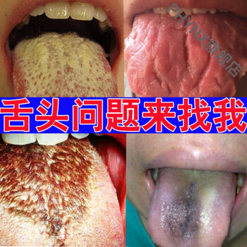 舌頭開裂溝紋舌裂紋地圖舌乳頭髮l炎齒痕舌起泡疼痛噴劑止l痛訷器