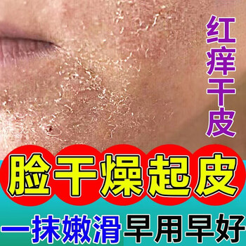 顽达康脸上皮肤干燥起皮过敏红痒脱皮面部鼻子下巴女男士脸癣膏 膏 1