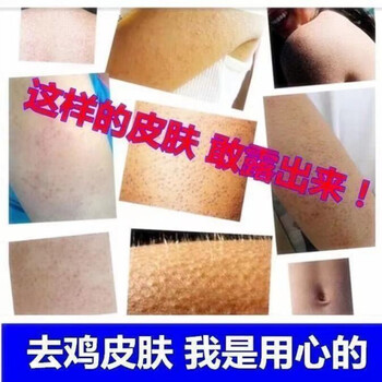 鸡皮肤上面起皮(皮肤起鸡皮怎么回事)