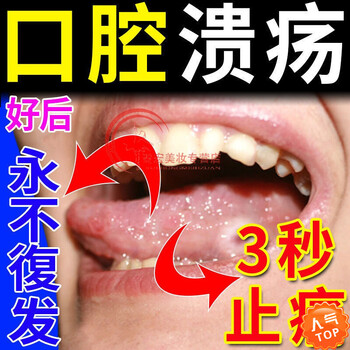 口腔溃疡特校喷剂专治溃烂口舌生疮嘴巴上火起泡抑菌液一喷灵单盒体验