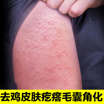 全身手臂上的疙瘩小腿脱皮去鸡皮肤疙瘩毛囊角化祛鸡皮疙瘩毛周2盒50