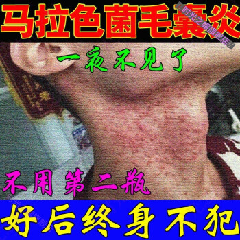 馬拉色菌臉部頭部胸部毛囊堵塞痤i瘡修復膏毛囊炎馬拉色菌毛囊炎臉部