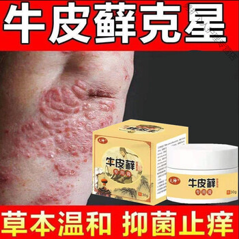 治l疗牛皮l癣银l屑病特效专用膏手足l癣头皮l癣老偏方克星顽固性止痒