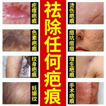 膏全身凹凸燒燙傷手術除l疤痘坑痘印痘疤妊辰紋剖腹產傷疤增生性瘢痕