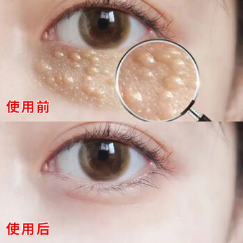 专攻脂肪粒去除南方协和草本眼部精华去汗管瘤眼霜油脂粒祛除扁平粒1