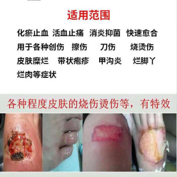 雲南金創散傷口癒合劑擦傷甲溝炎燒傷燙傷摔傷外傷褥瘡健康白藥粉買32