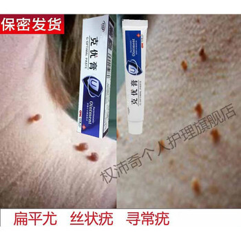 官方精选疣必治疣瘊肉粒一抹无忧疣必净疣瘊平软膏疣必治克