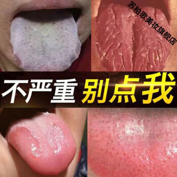 嚴重舌i炎舌頭麻木疼痛口乾白斑口腔扁平苔蘚舌炎舌頭起泡口腔黏膜發