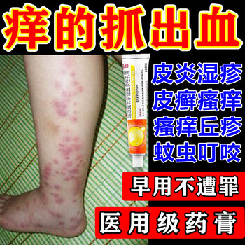 上红疙瘩皮肤瘙痒止痒膏药皮炎湿疹皮癣真菌感染止痒荨麻疹过敏止痒药