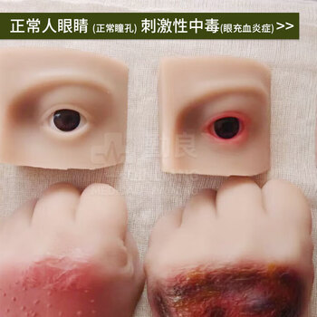 勤良伤情呈现训练模拟器材 人员中毒仿真模型 路易士气 芥子气 中毒模型 卫勤训练器材QL/C016