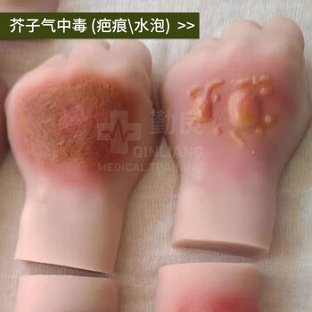 勤良伤情呈现训练模拟器材 人员中毒仿真模型 路易士气 芥子气 中毒模型 卫勤训练器材QL/C016