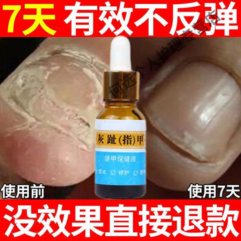 治灰指甲名灰指甲恢复灰指甲液专用甲沟焱脱甲膏增厚轻度一盒体验装