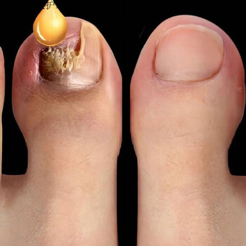 【30分钟脱灰甲】灰指甲专用护理液软甲膏去i除灰指甲 1瓶软甲膏