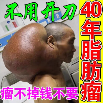 脂肪瘤去除神器【不手術】專消48種皮下脂肪瘤硬快囊腫專用噴劑 - 單